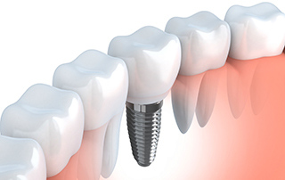 Dental Implants Farmingdale